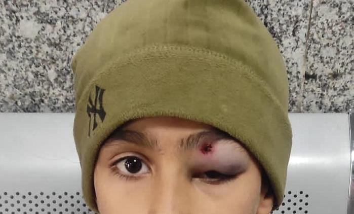You are currently viewing Primary School Head’s Brutal Punishment Leaves Child with Severe Eye Injury, Risking Permanent Blindness